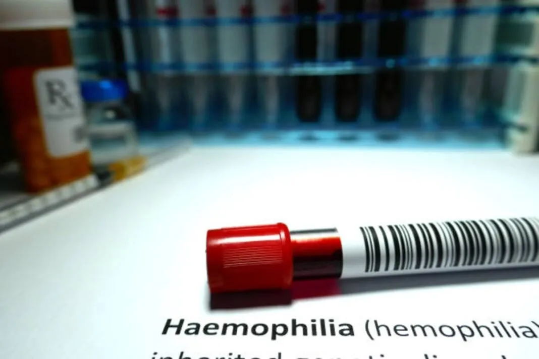 Hemophilia Patients in Gujarat: ગુજરાતમાં હિમોફિલિયા રોગનો ઉદ્ભવ : 7000થી વધુ દર્દીઓ નોંધાયા, જાણો લક્ષણો અને ગંભીરતા ક્યારે વધી શકે?